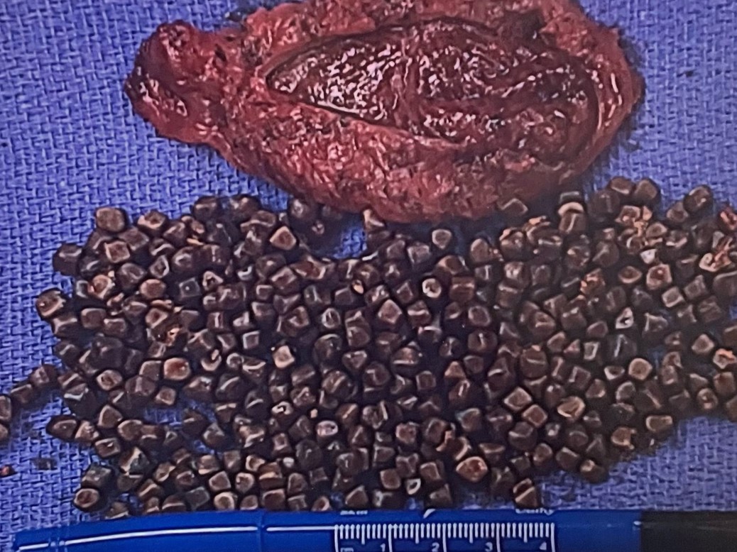 The Edge Acute Cholecystitis